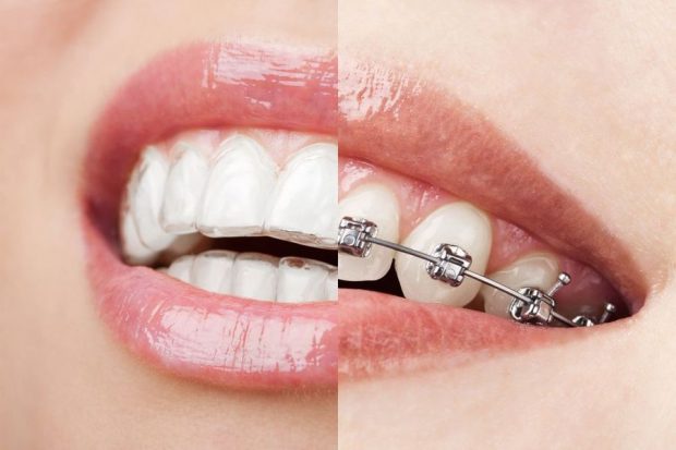Commonly Asked Questions About Removable Braces
