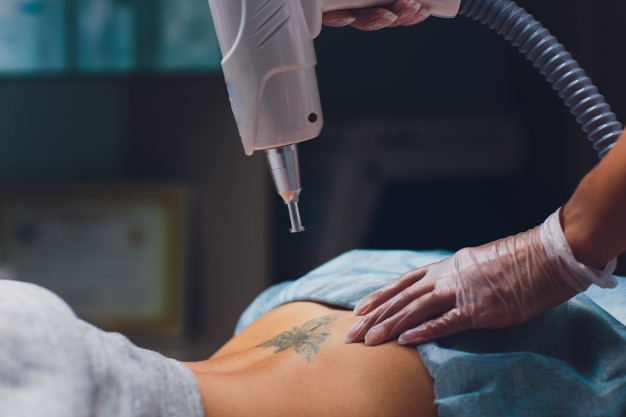 Things You Should Know About Tattoo Removal