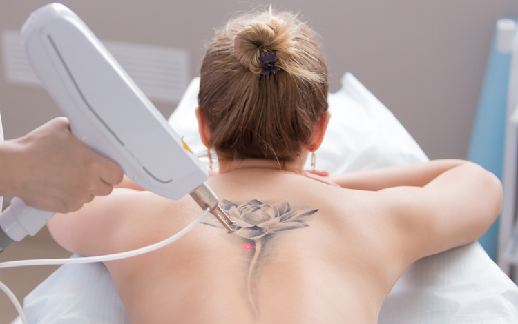 You Should Know About Tattoo Removal