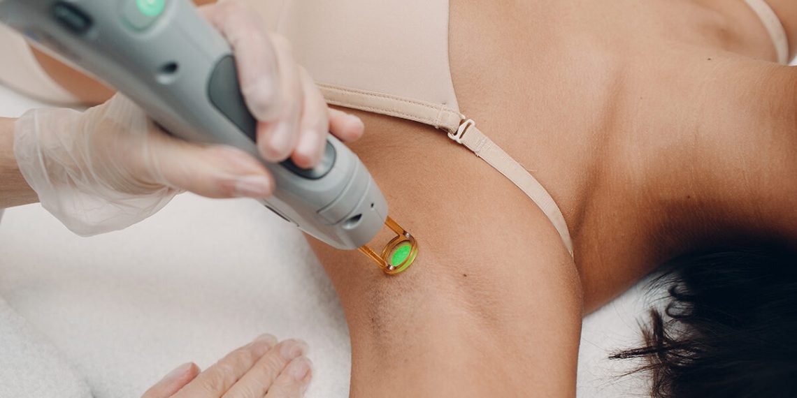 hair laser removal