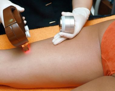 Preparing for and Aftercare of Laser Hair Removal