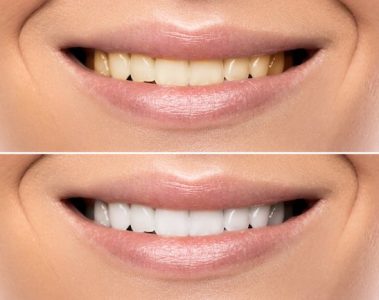Guide to Complete Smile Makeovers