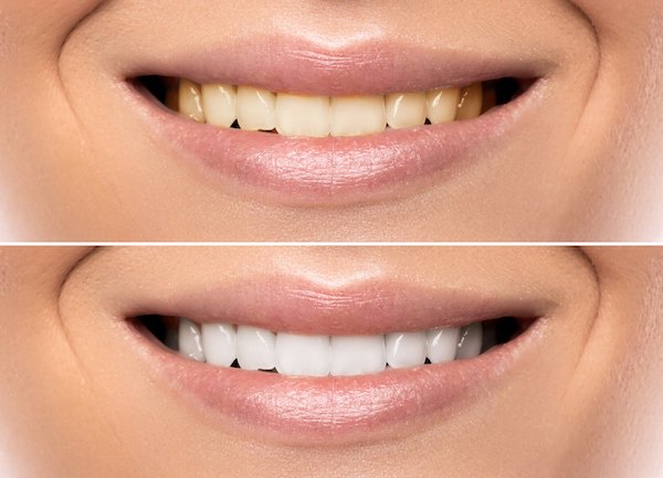 Guide to Complete Smile Makeovers