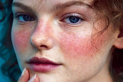 how hydra facials help with treating rosacea?